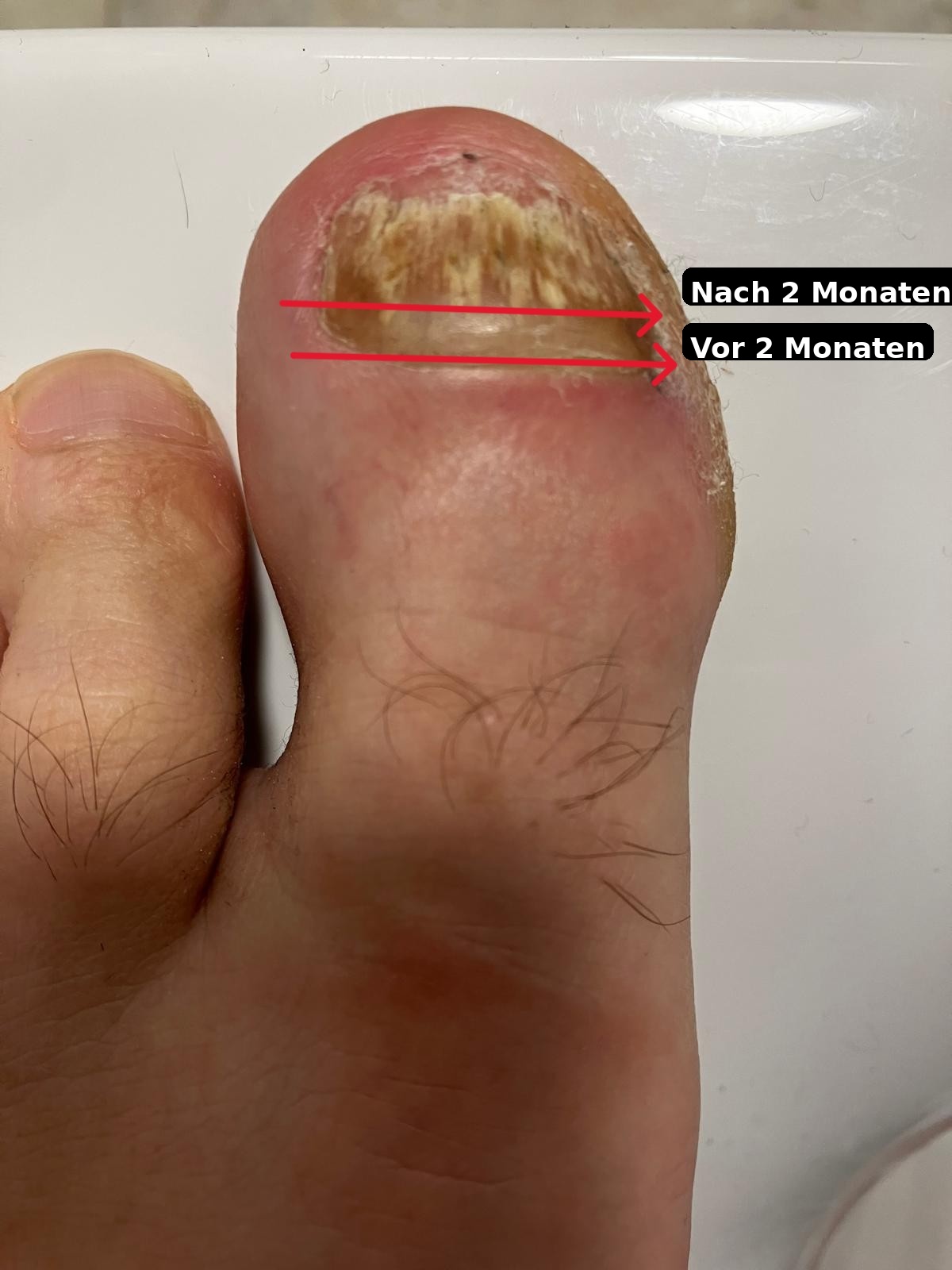 Bei mir fing es vorne am großen Zeh mit einem gelben Bereich an – später wurde der Nagel dicker und bröselig.