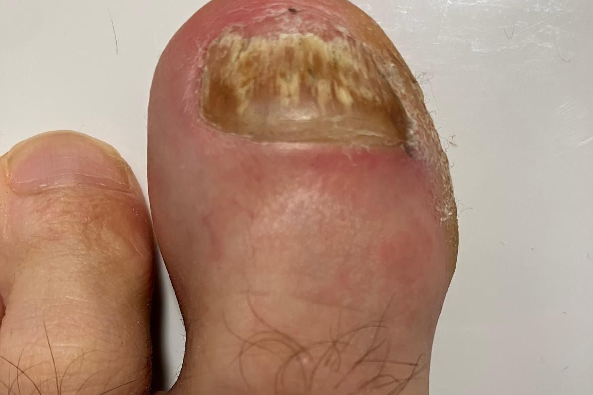 Nagelpilz am großen Zeh – Ausgangszustand bei mir