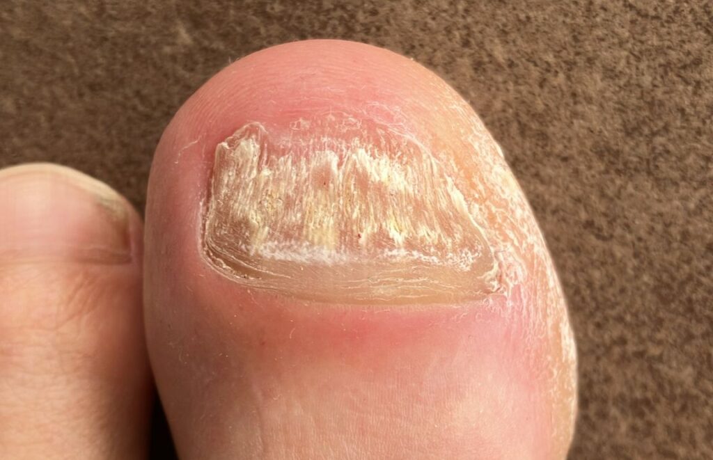 Fortschritt am Zehennagel nach Anwendung von Amorolfin Nagellack