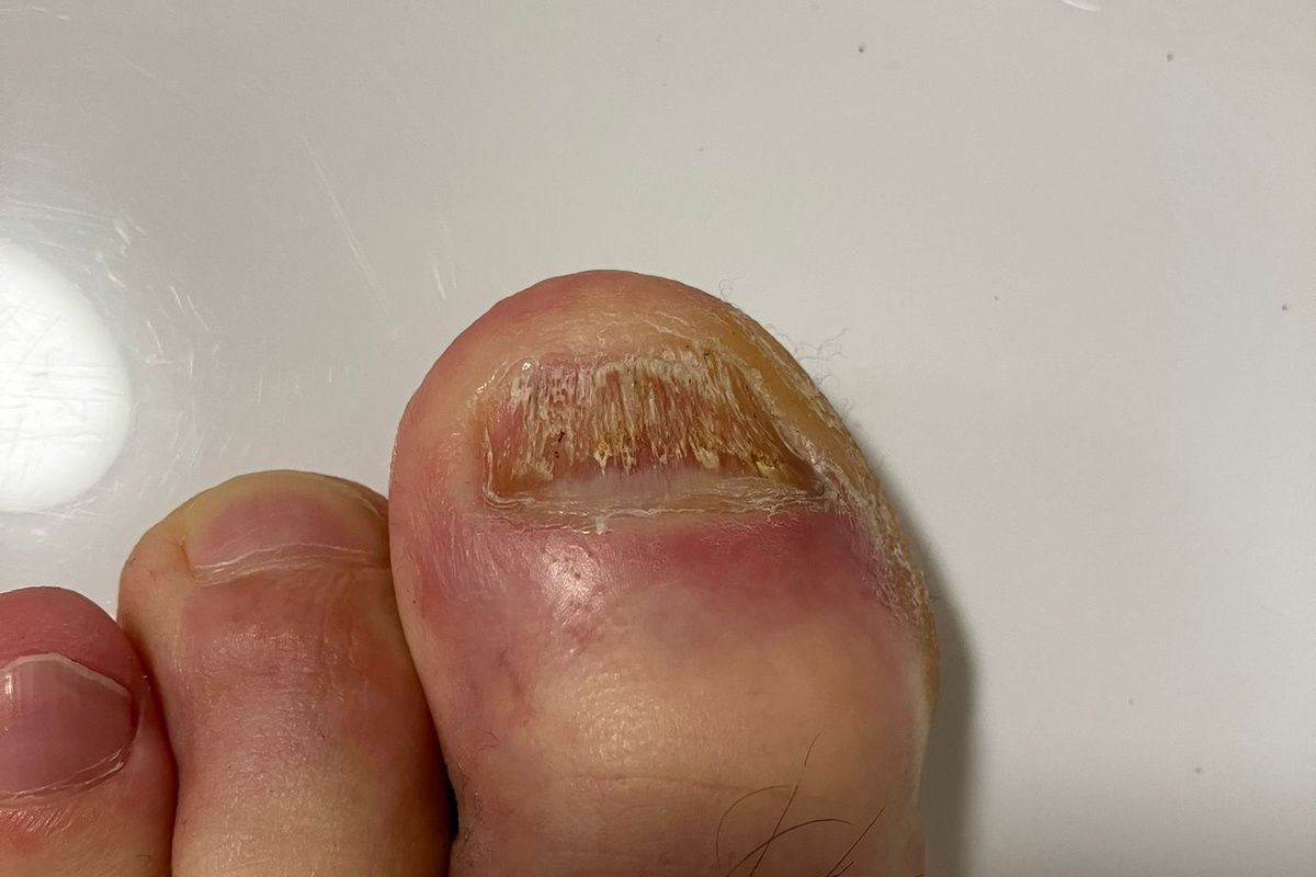 Großer Zehennagel während der Behandlung mit Amorolfin