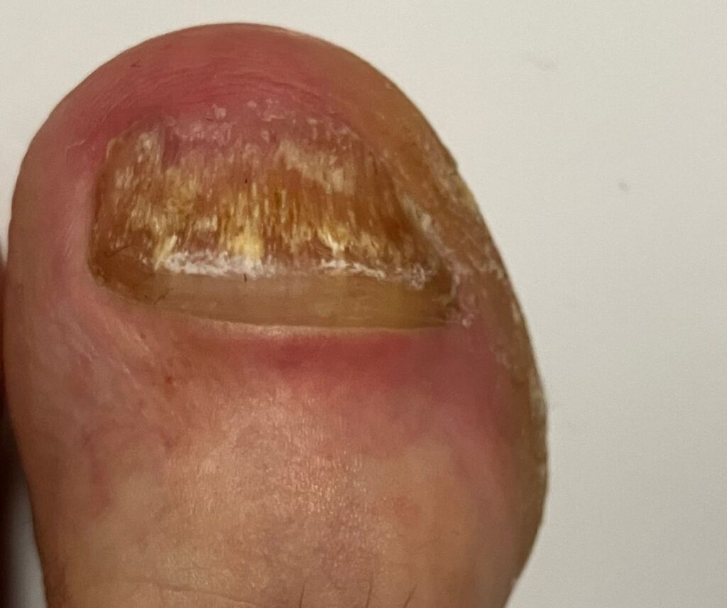 Gesunder Nachwuchs am linken großen Zeh nach Nagelpilz