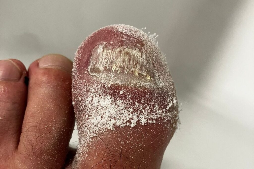 Großer Zehennagel nach dem vorsichtigen Glätten mit dem Nagelfräser