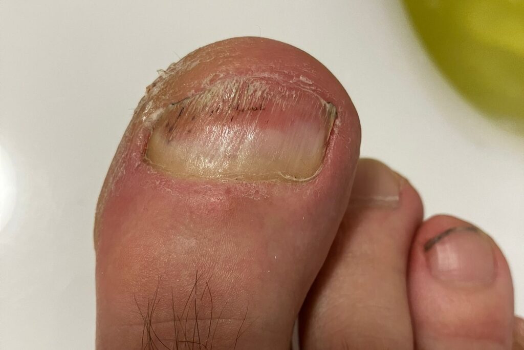 Nagelansatz mit gesünder nachwachsendem Zehennagel