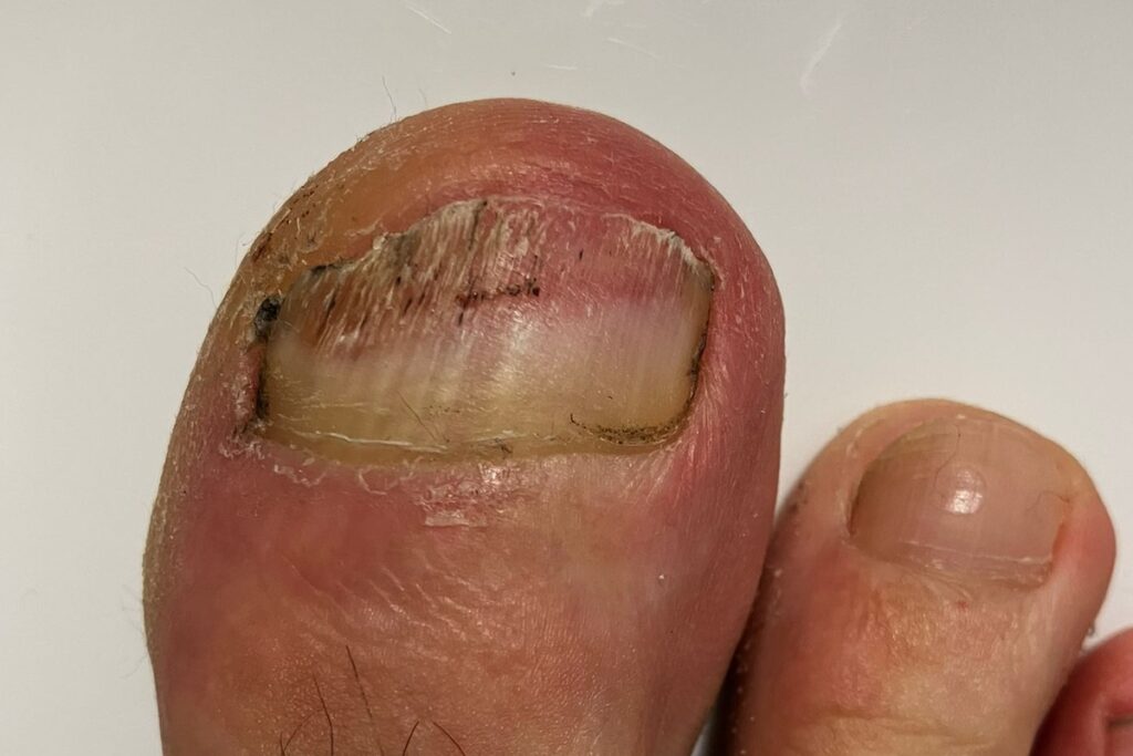 Rechter großer Zehennagel mit teilweise befallenem Nagel durch Nagelpilz