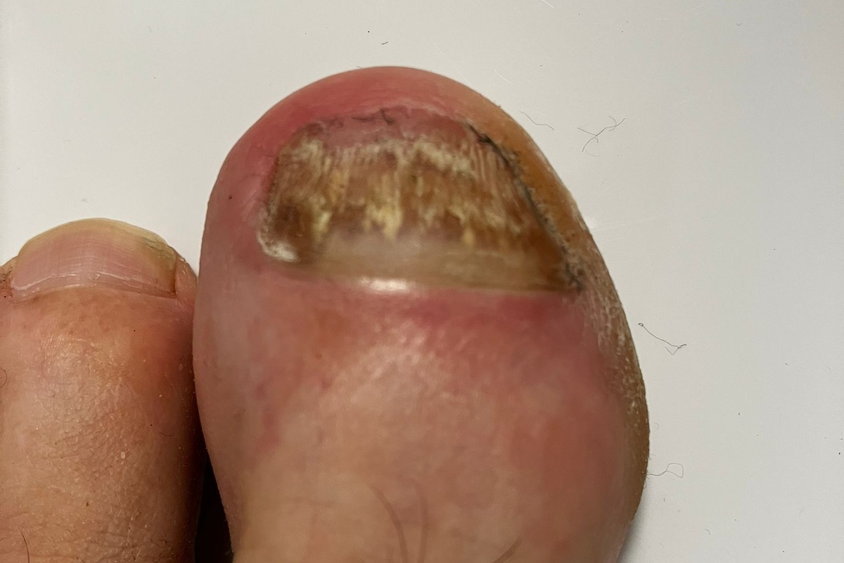 Linker großer Zeh mit gelblicher Verfärbung und Nagelpilz am Anfang