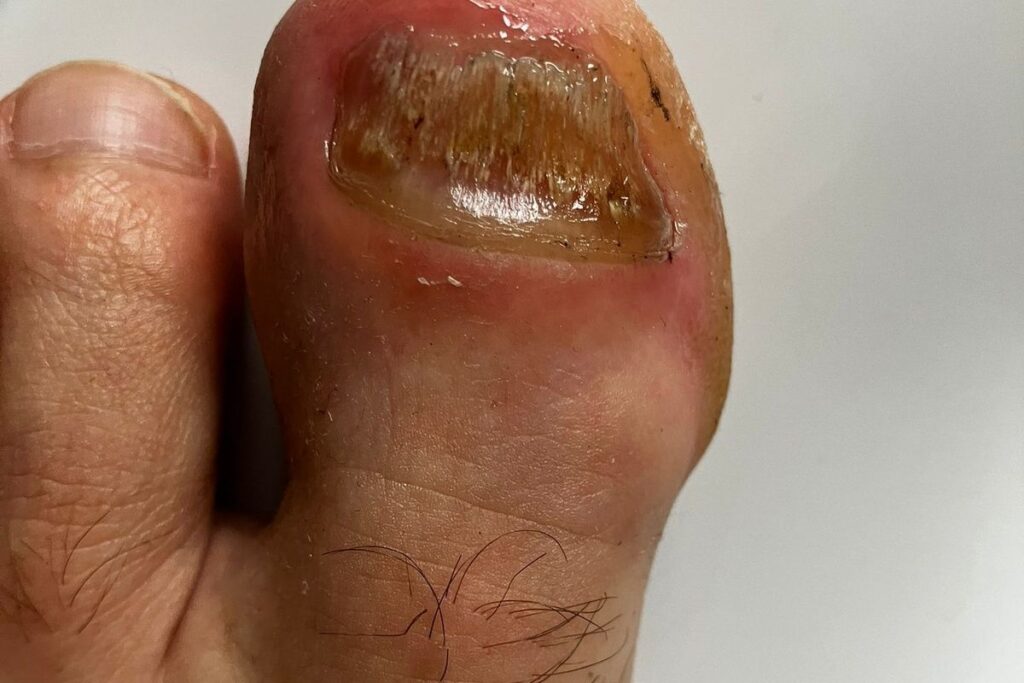 nagelpilz großer zeh gelb brüchig anfang