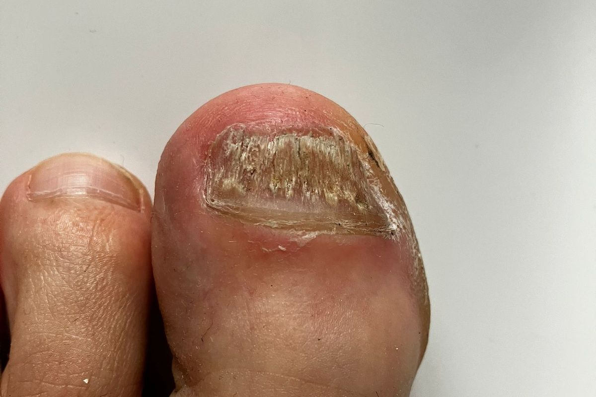 nagelpilz großer zeh kommt immer wieder zurück