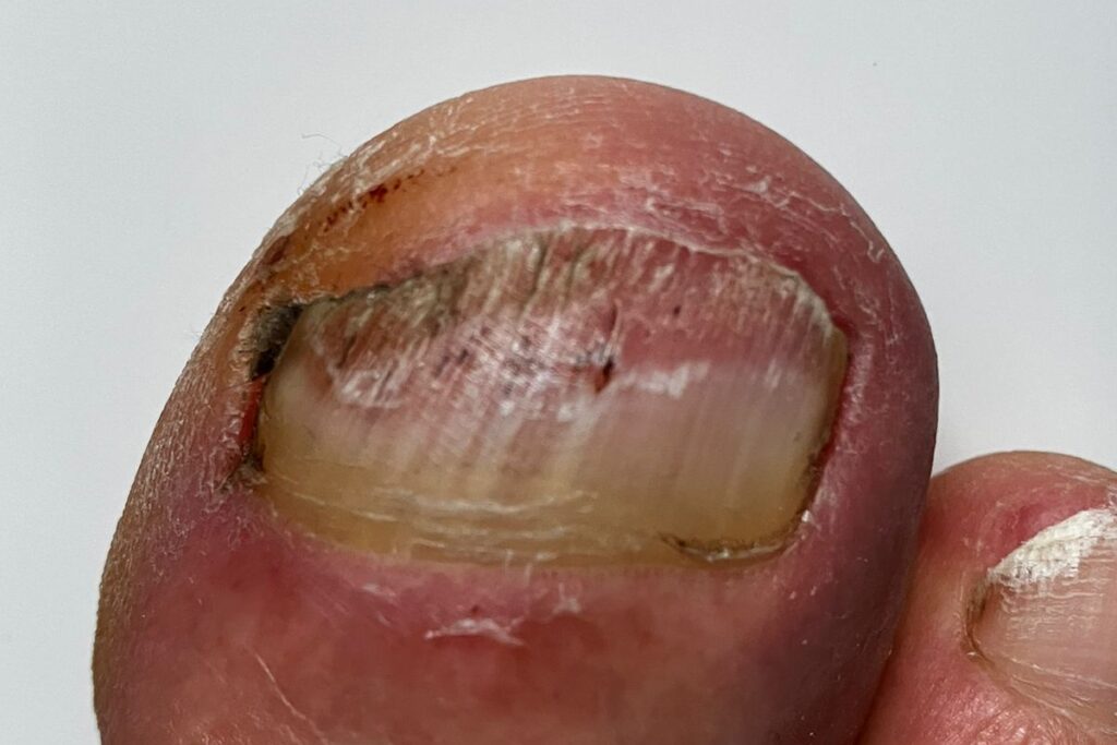 Nagelpilz am großen Zeh: gelbliche Verfärbung und unebener Zehennagel