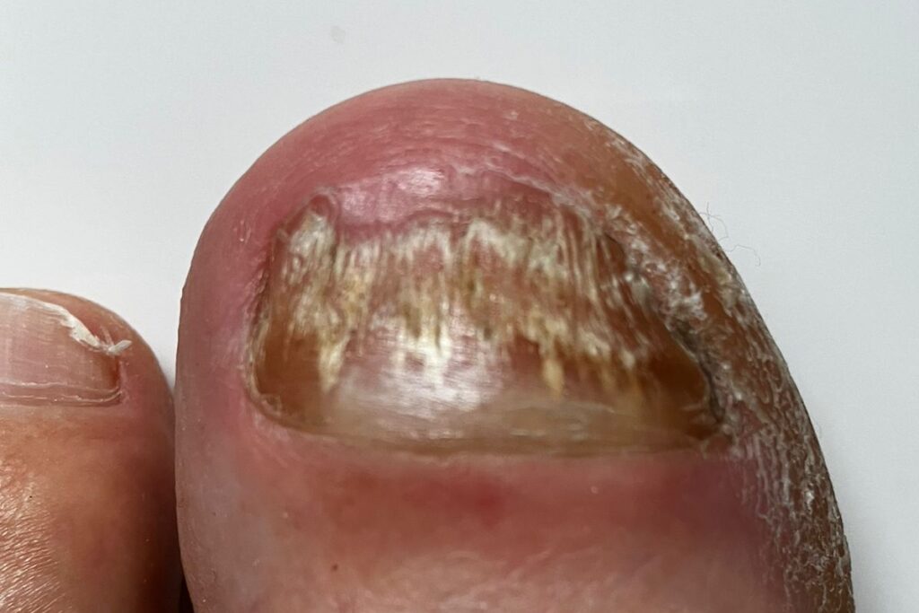 Bröseliger und dicker Zehennagel am großen Zeh bei Nagelpilz