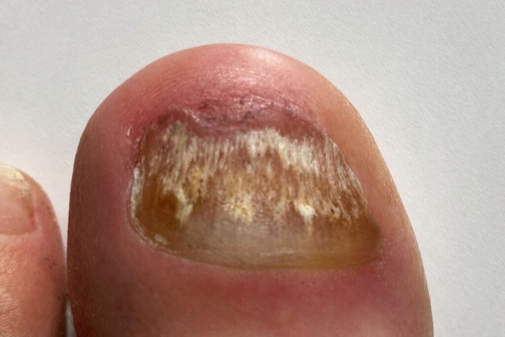 Großer Zeh mit verfärbtem Nagel und sichtbaren Veränderungen durch Nagelpilz