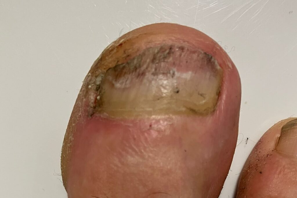 Zehennagel mit dickem und bröseligem Nagelpilz-Befall