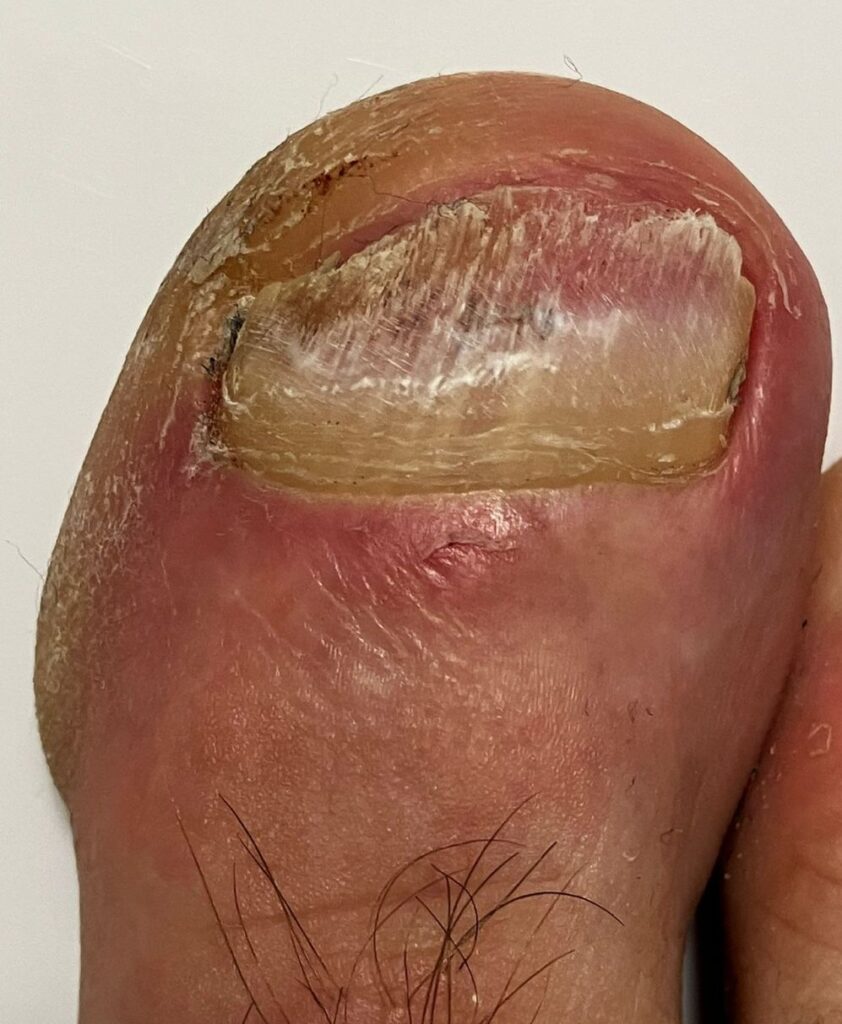 Rechter Zeh mit teilweise befallenem Nagel durch Nagelpilz