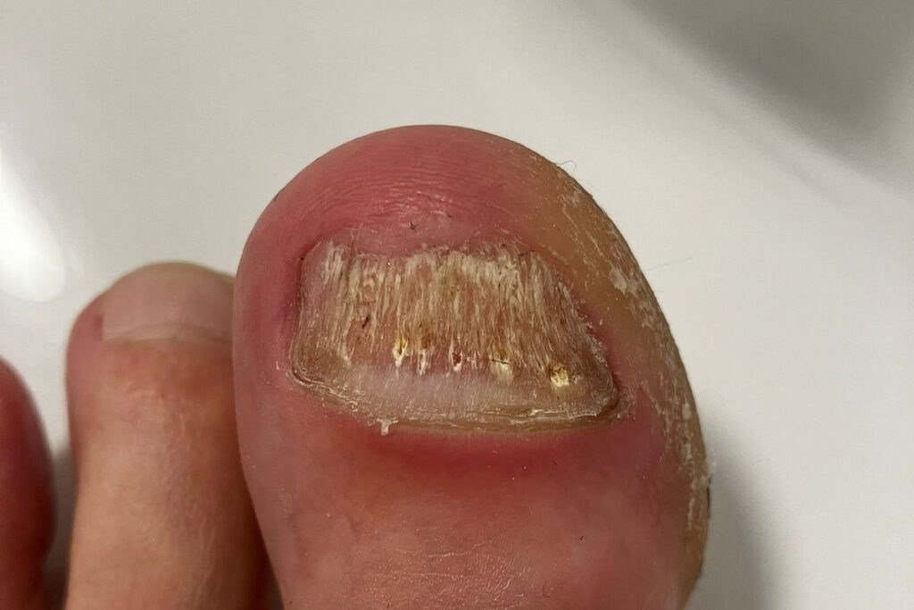 Großer Zehennagel nach dem Entfernen von Nagelstaub