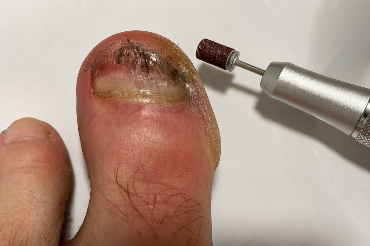 Dicke Fußnägel fräsen mit Nagelfräser bei verdicktem Zehennagel