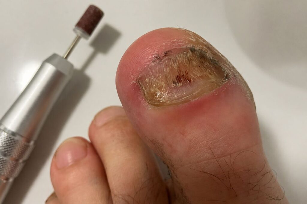 Nagelfräser für dicke Zehennägel aus meiner Erfahrung