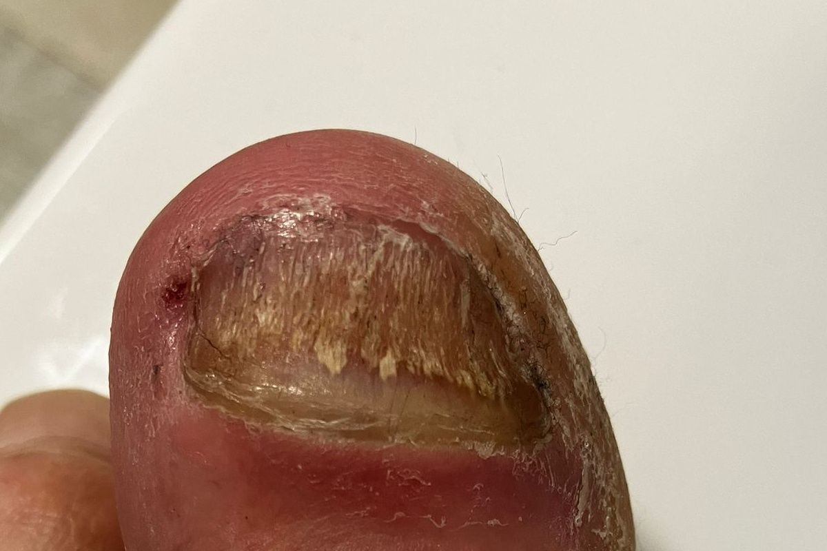 nagelpilz hausmittel erfahrung großer zeh