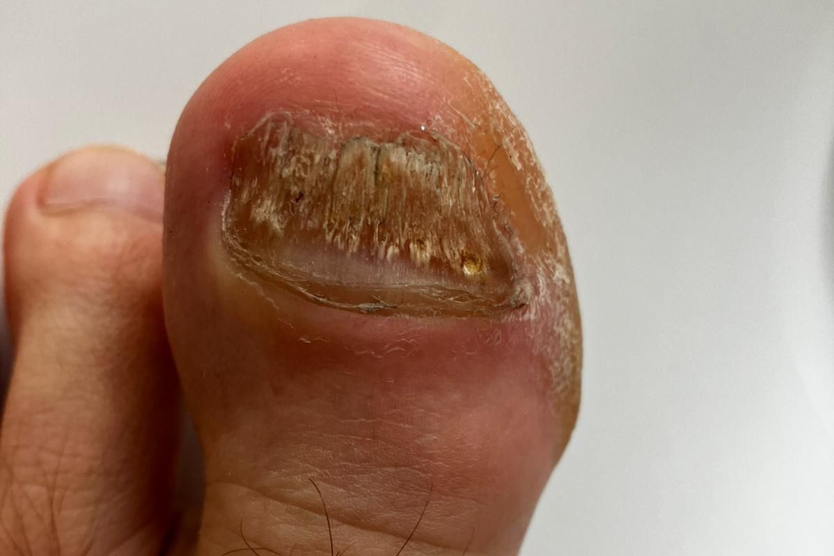 nagelpilz großer zeh kommt immer wieder zurück