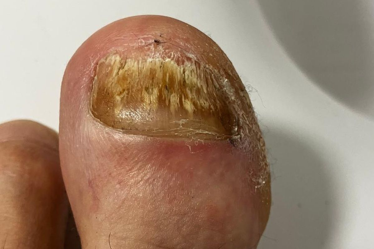 nagelpilz nach 1 jahr noch da großer zeh