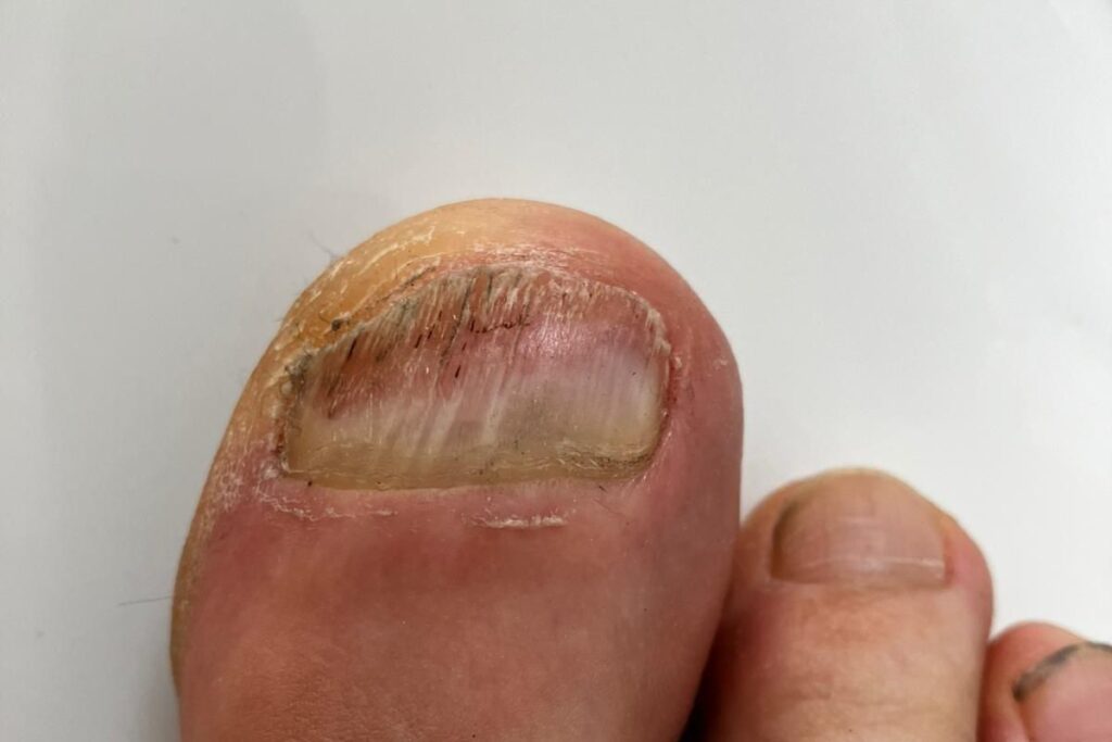 nagelpilz rückfall verlauf großer zeh