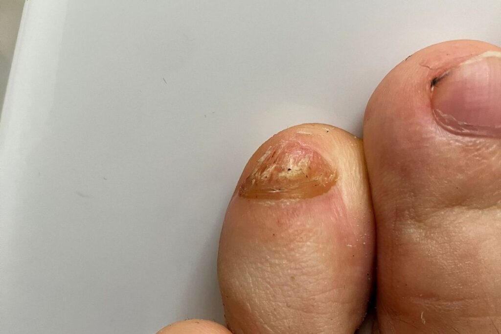 nagelpilz wird schlimmer trotz behandlung großer zeh