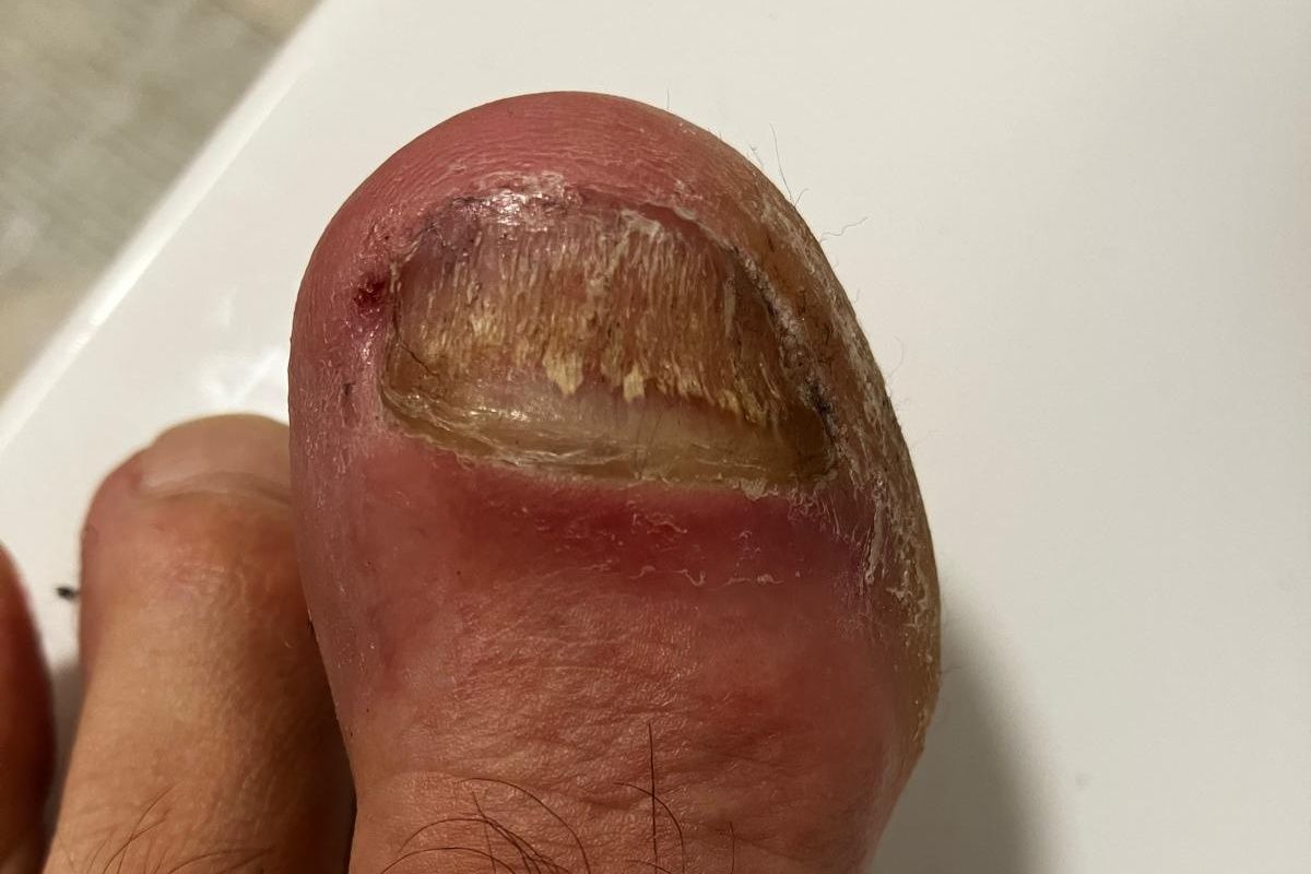 teebaumoel gegen nagelpilz erfahrung grosser zeh