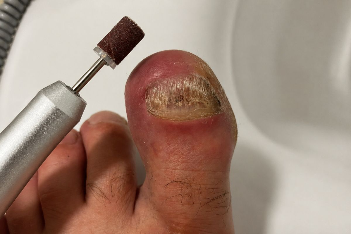 Verdickter Zehennagel mit möglicher Ursache wie Nagelpilz