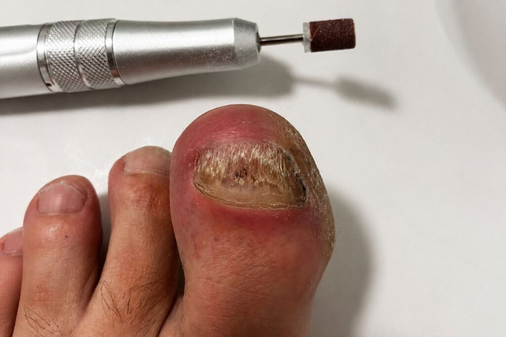 Verdickter Zehennagel und Nagelfräser im Alltag