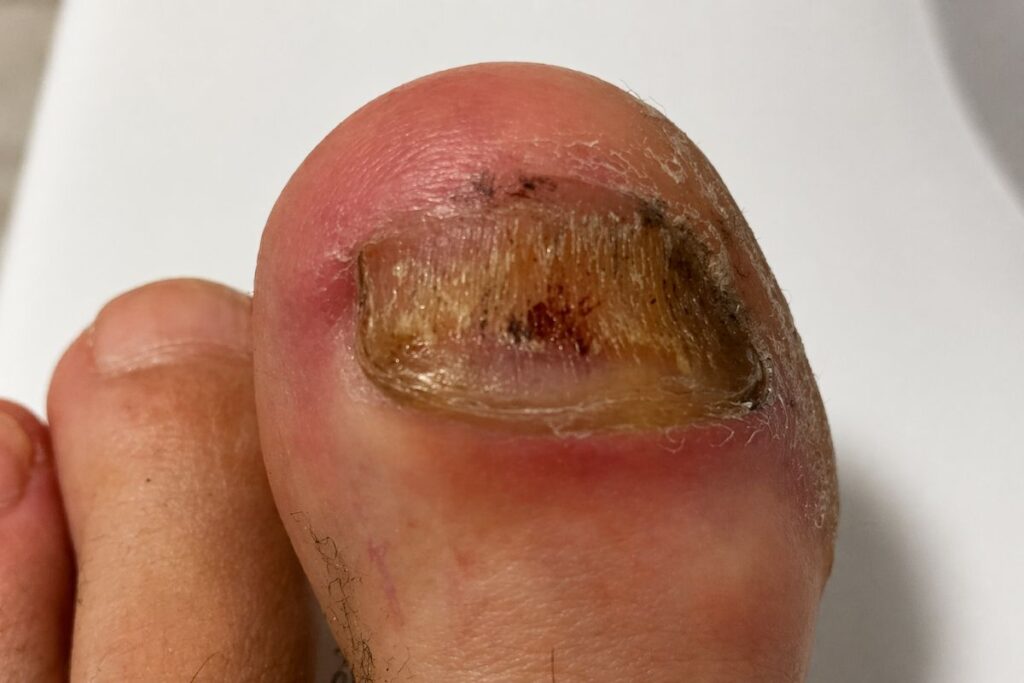 Verdickter Zehennagel vor dem Fräsen bei Nagelpilz