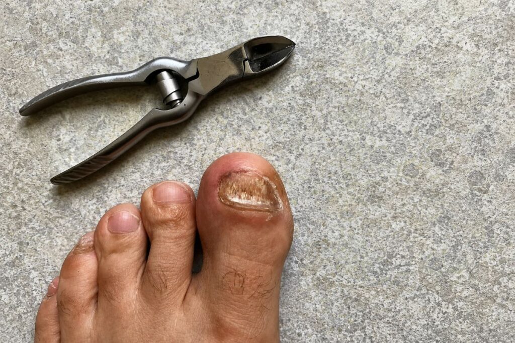 Dicke Zehennägel schneiden mit Nagelzange