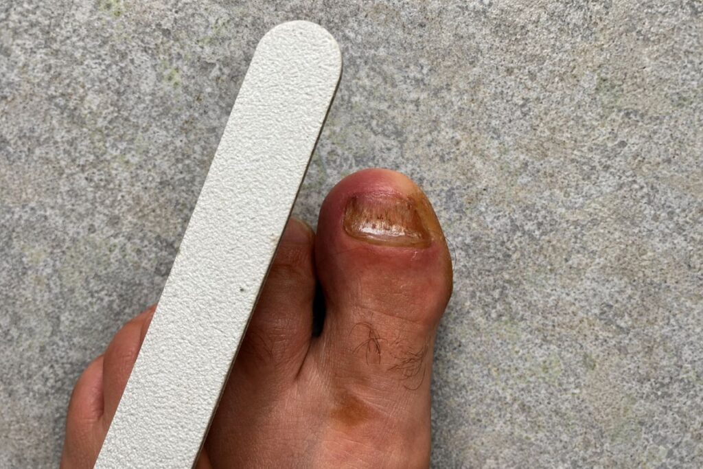 Feile neben verdicktem Zehennagel aus meiner Erfahrung