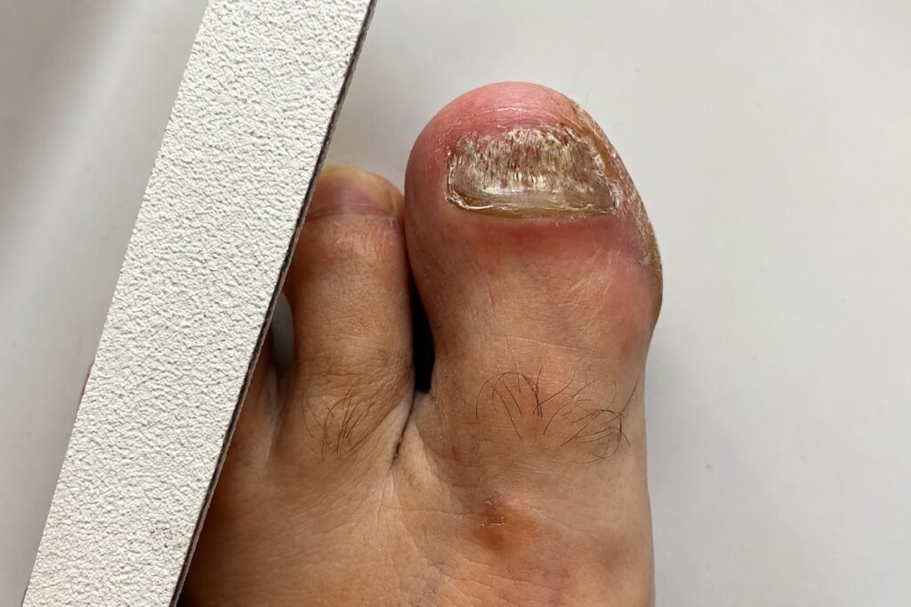 Nagelfeile bei Nagelpilz im Alltag