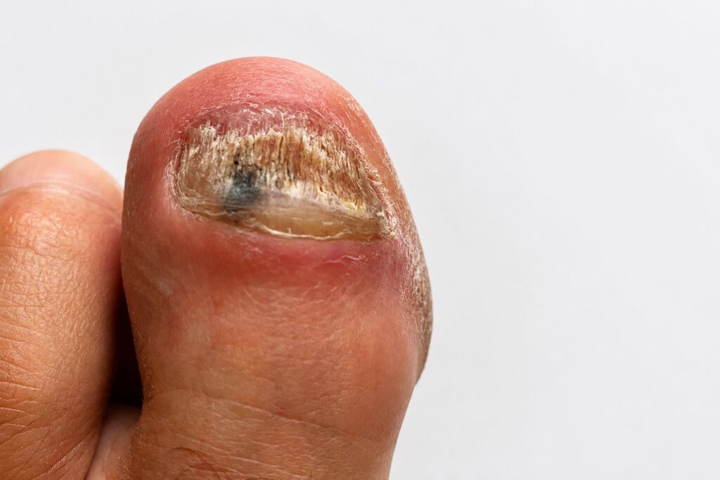 Großer Zehennagel löst sich teilweise vom Nagelbett