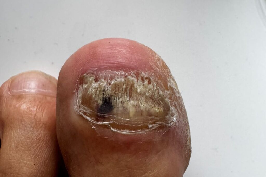 Material unter dem Zehennagel bei Nagelpilz