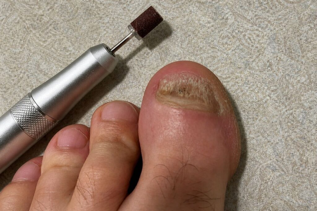 Nagelfräser bei dickem Zehennagel mit Nagelpilz