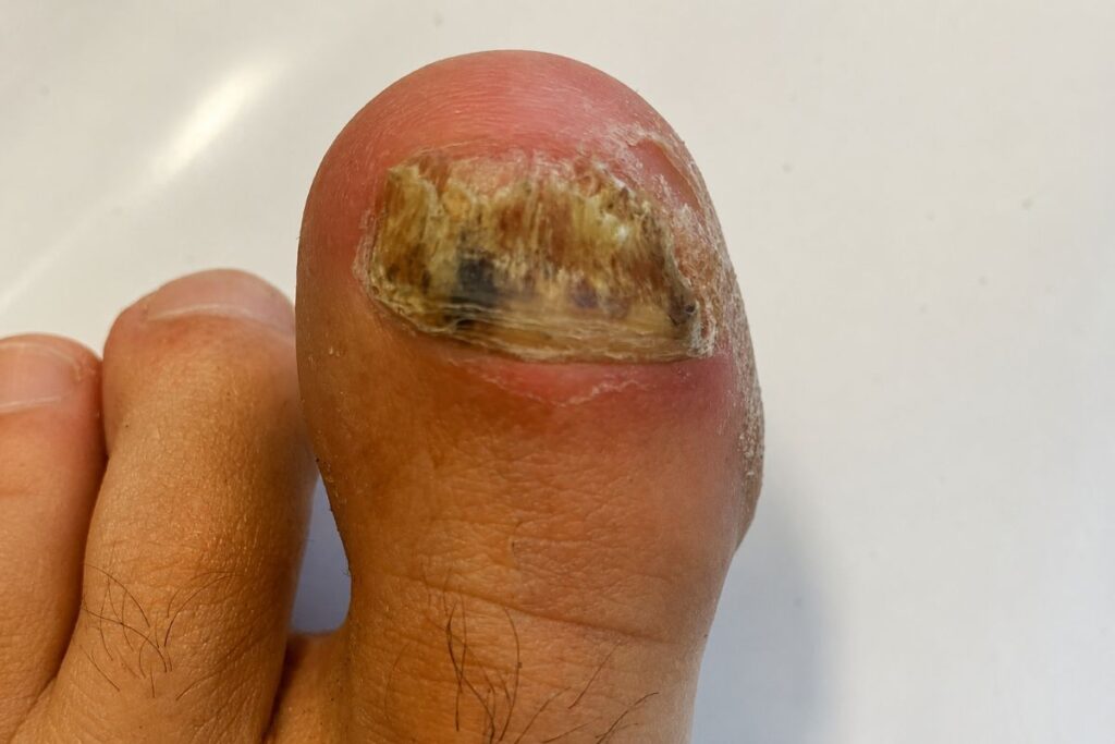 Dicker bröckeliger Zehennagel bei Nagelpilz