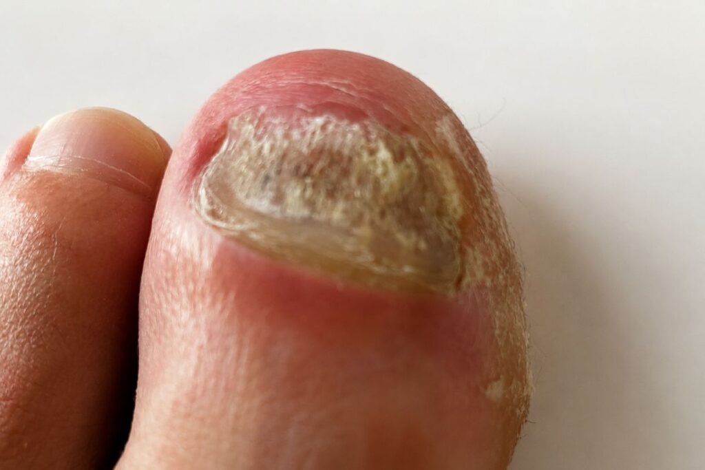 Gelber Zehennagel bei Nagelpilz