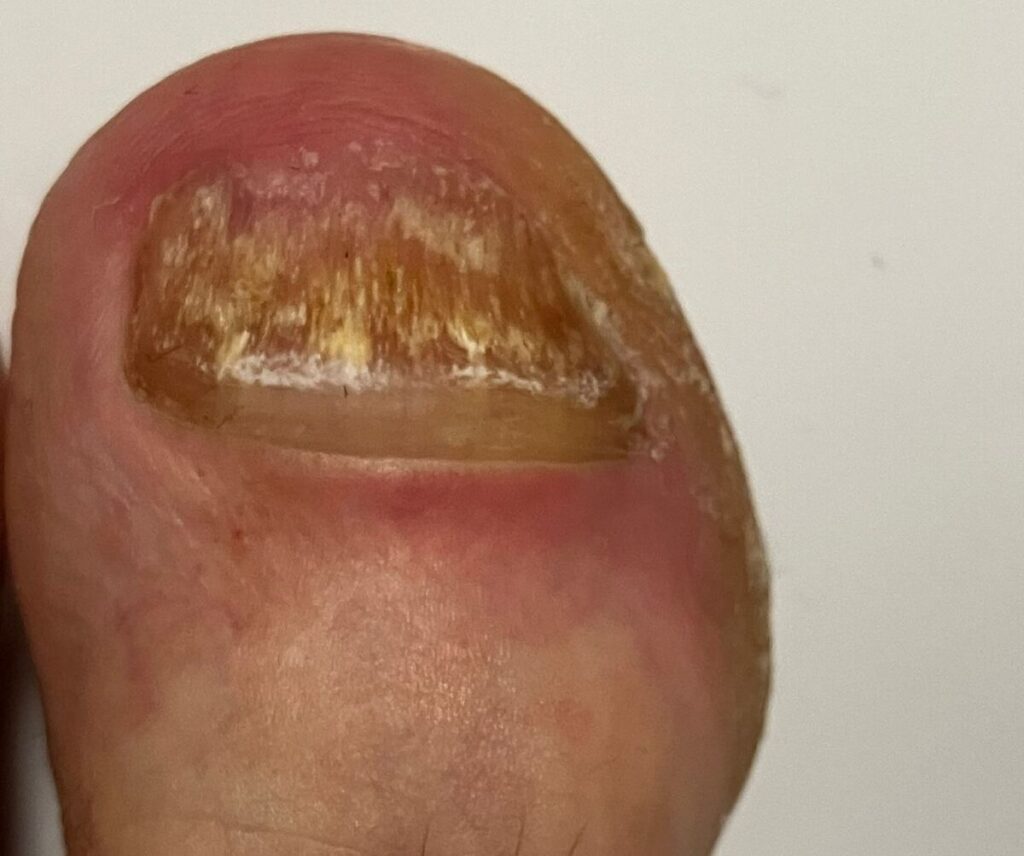 Gesunder Nagel wächst bei Nagelpilz nach