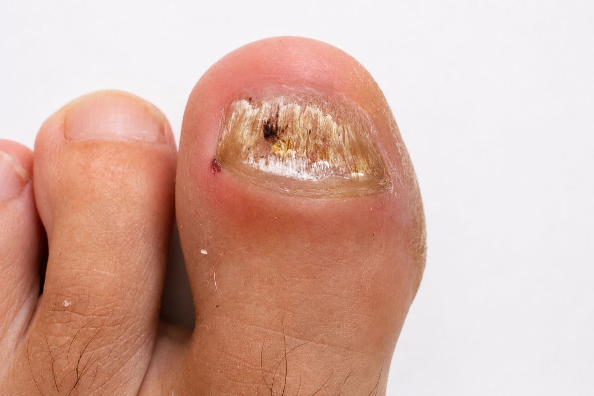 Nagelpilz Laser vorher nachher kritisch betrachten