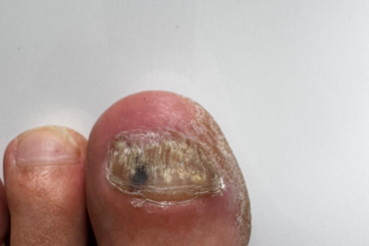 Nagelpilz Schmerzen am großen Zeh