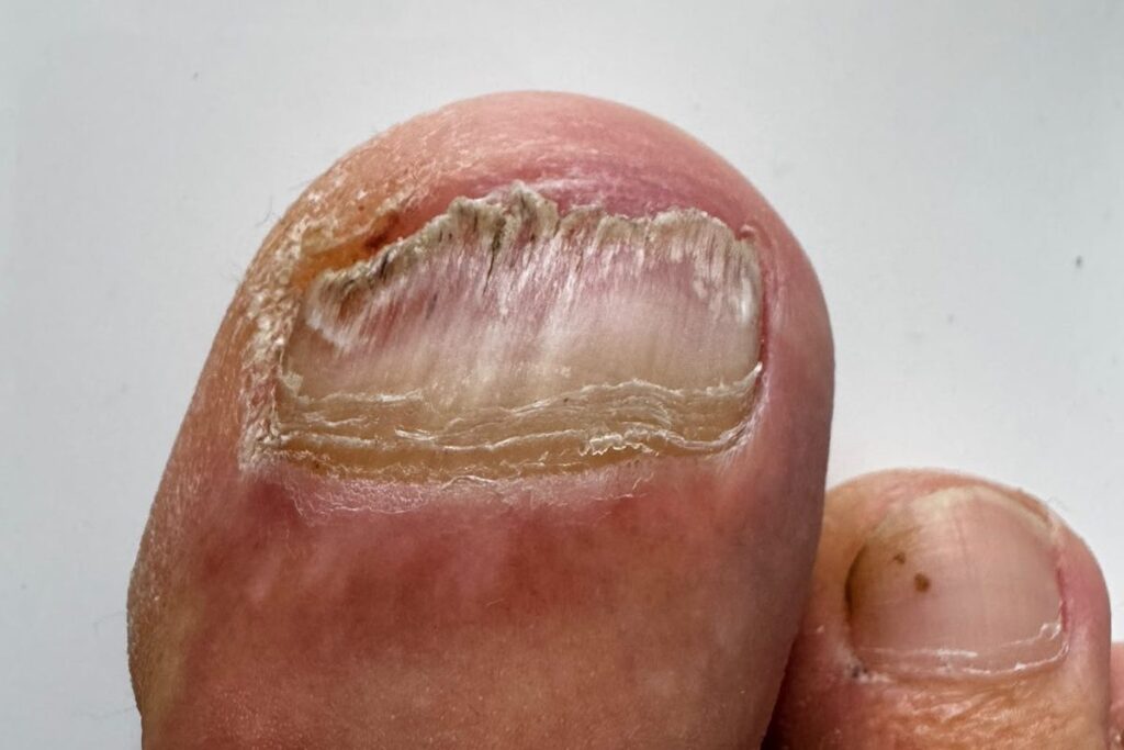 Material unter dem Zehennagel bei Nagelpilz