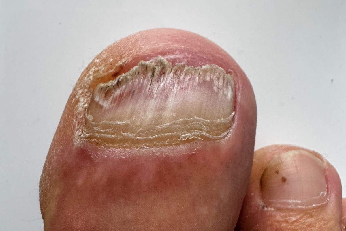 Nagelpilz unter dem Nagel