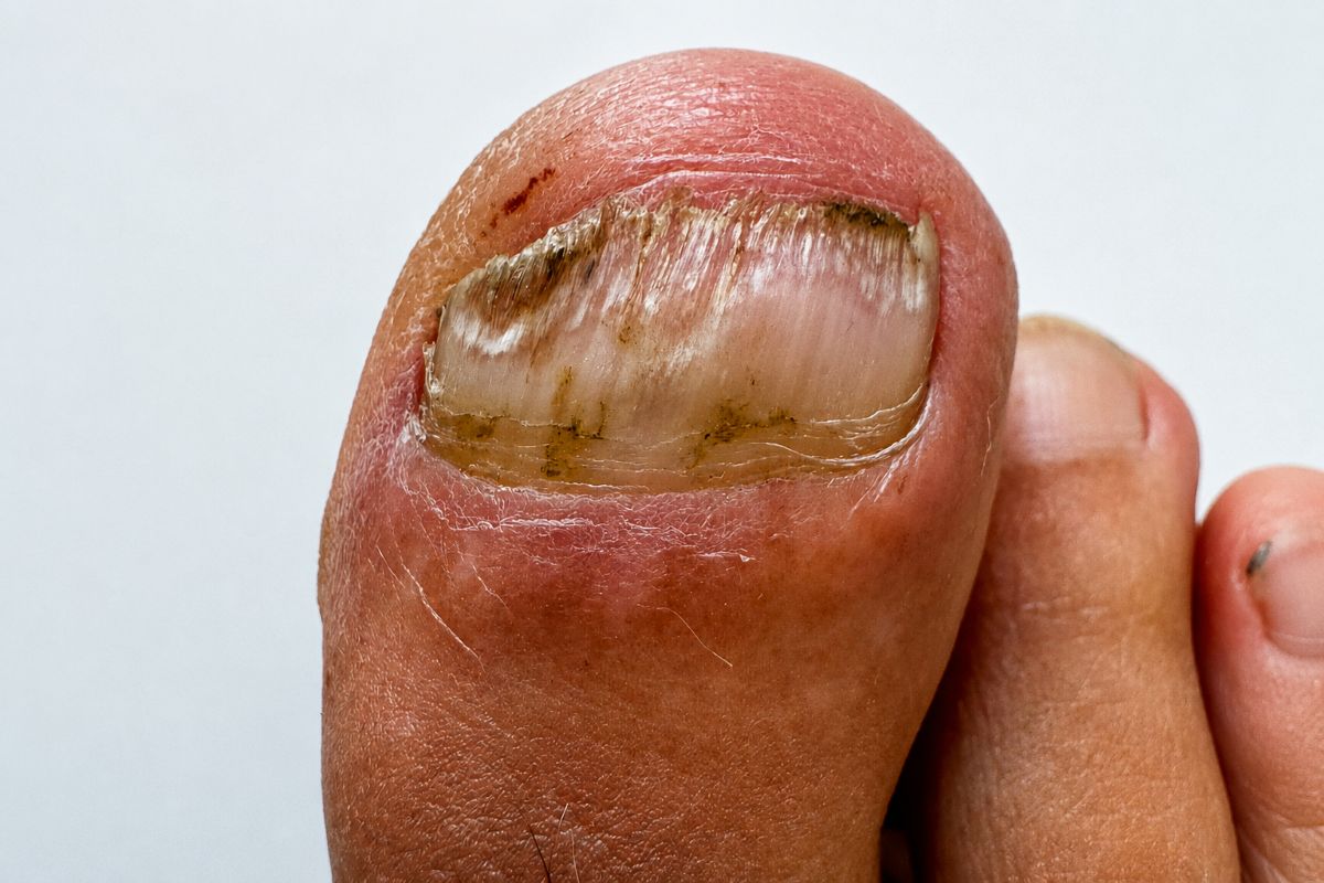 Nagelpilz vorbeugen aus eigener Erfahrung