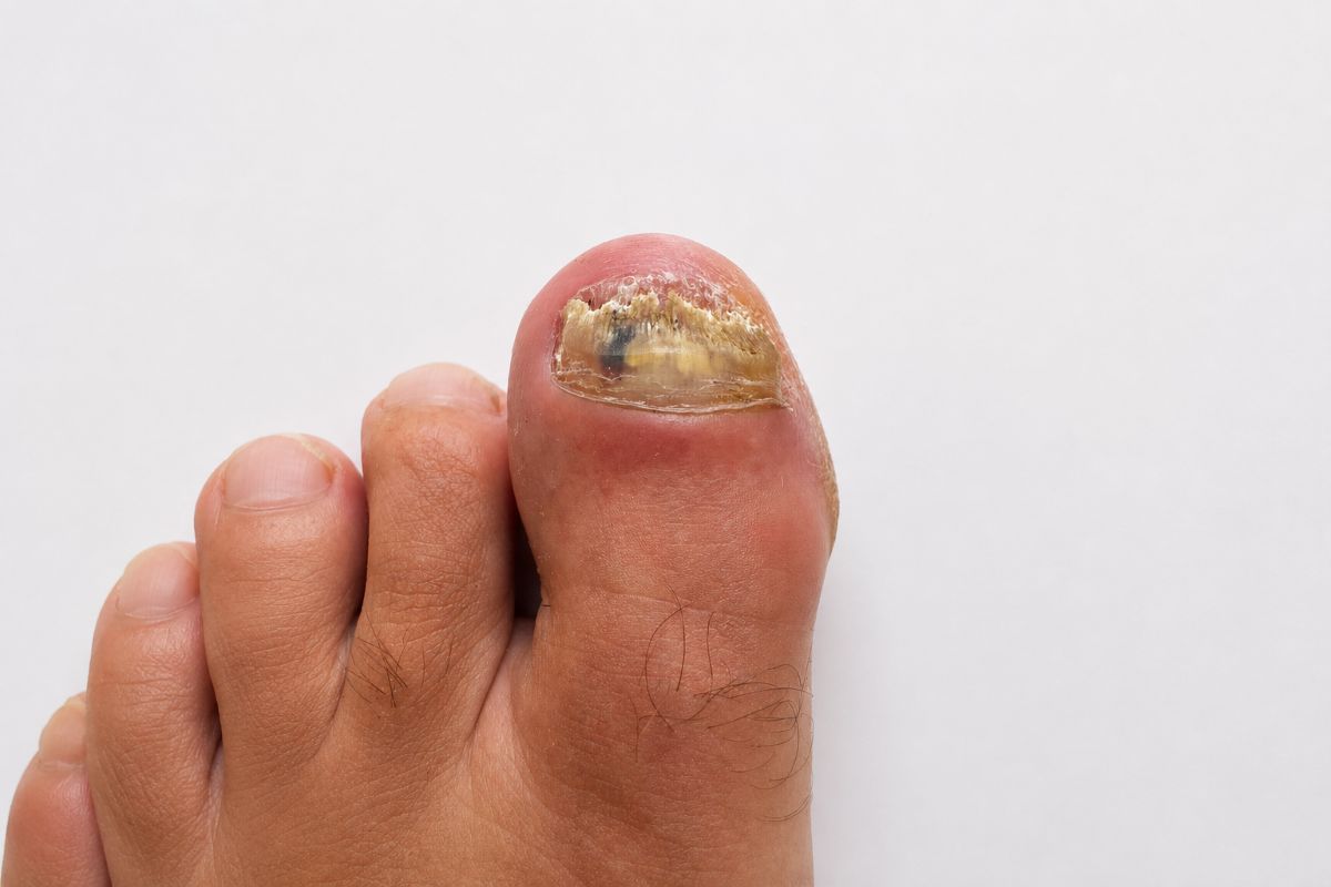 Nagelpilz welcher Arzt bei verändertem Zehennagel