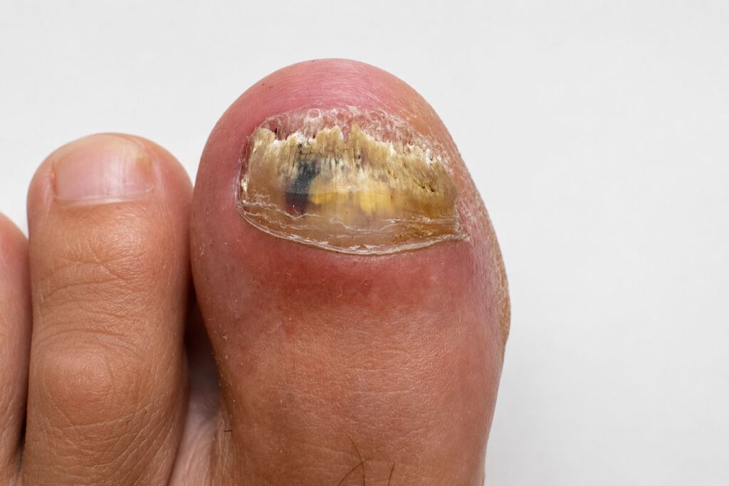 Veränderter Zehennagel vor der Nagelprobe bei Nagelpilz