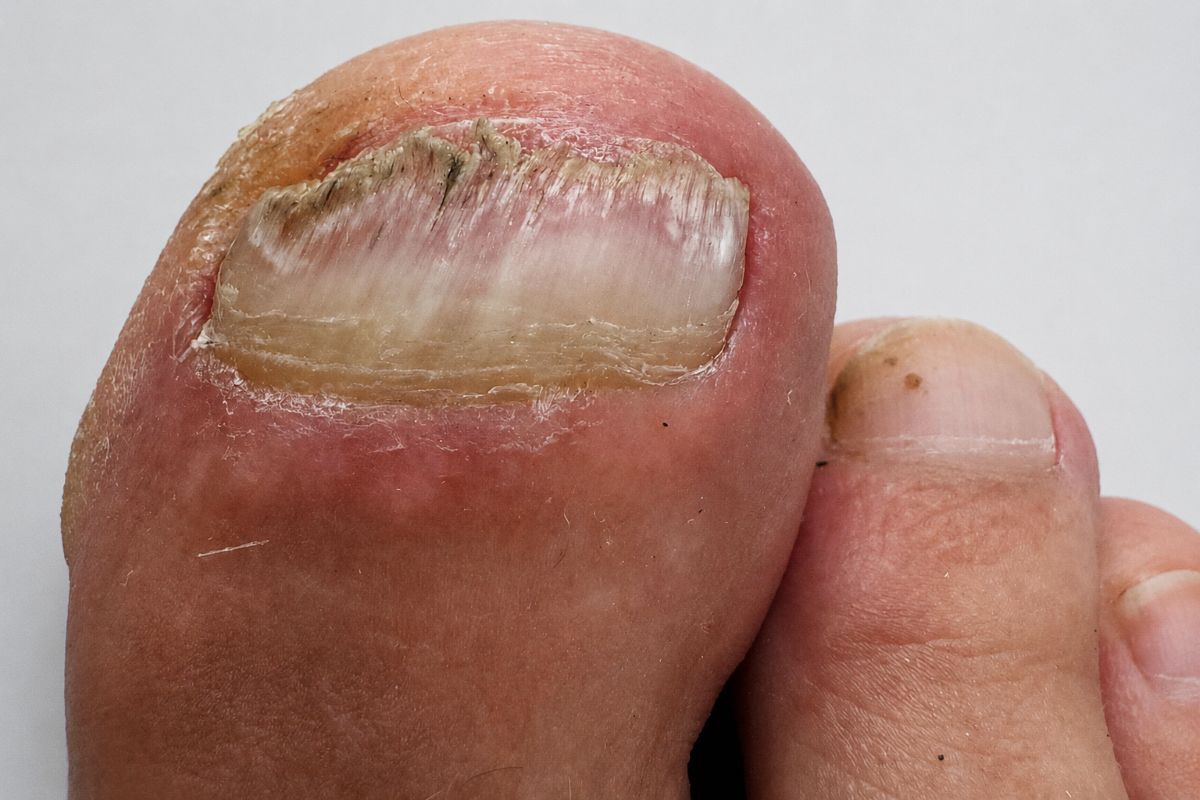 Weißer Zehennagel durch Nagelpilz oder trockene Oberfläche