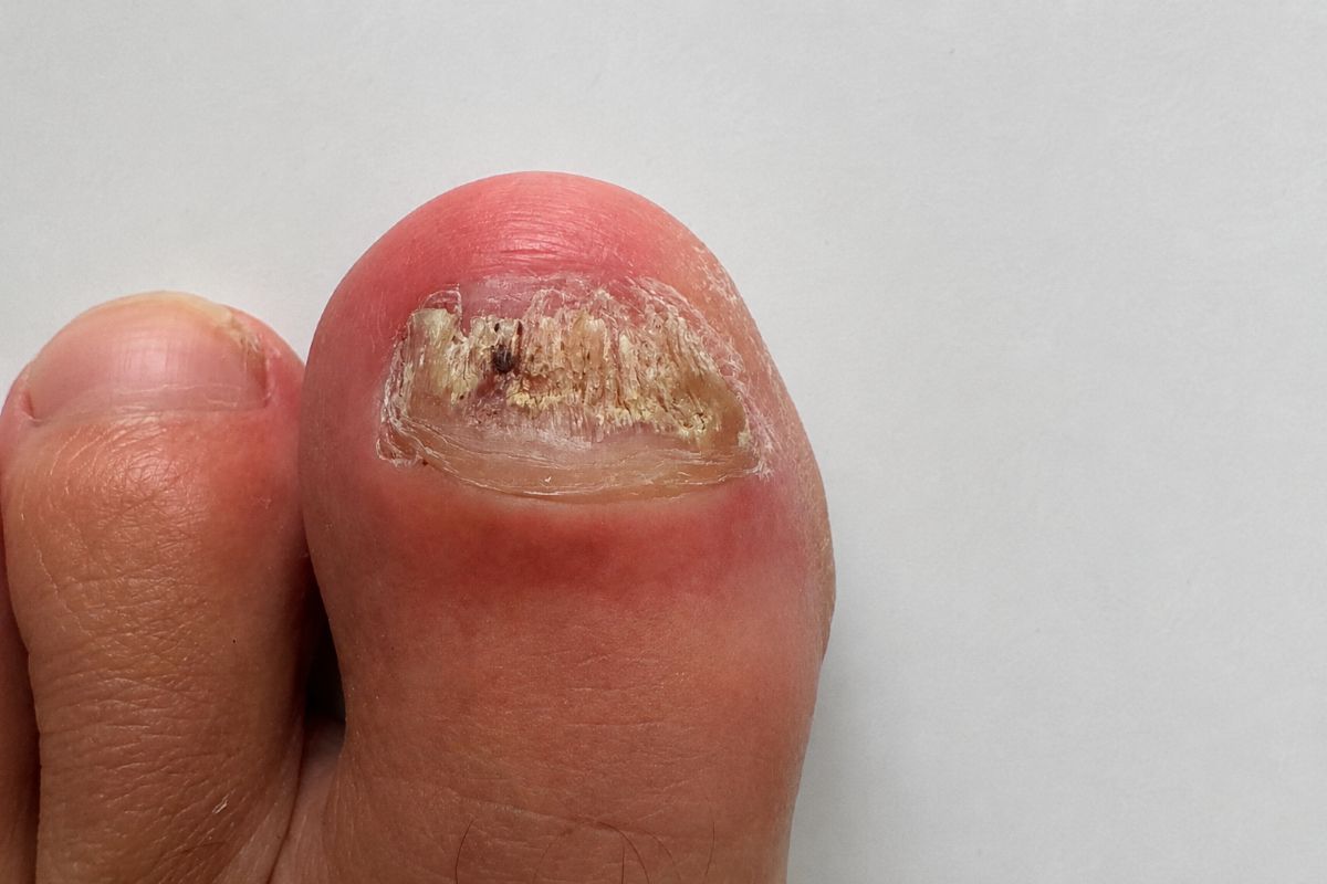 Fußbad gegen Nagelpilz Erfahrung am Zehennagel