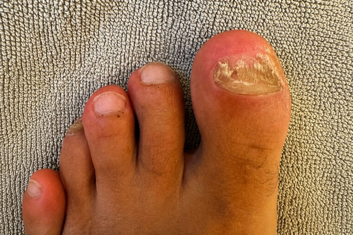Fußpilz zwischen den Zehen Erfahrung wegen Nagelpilz