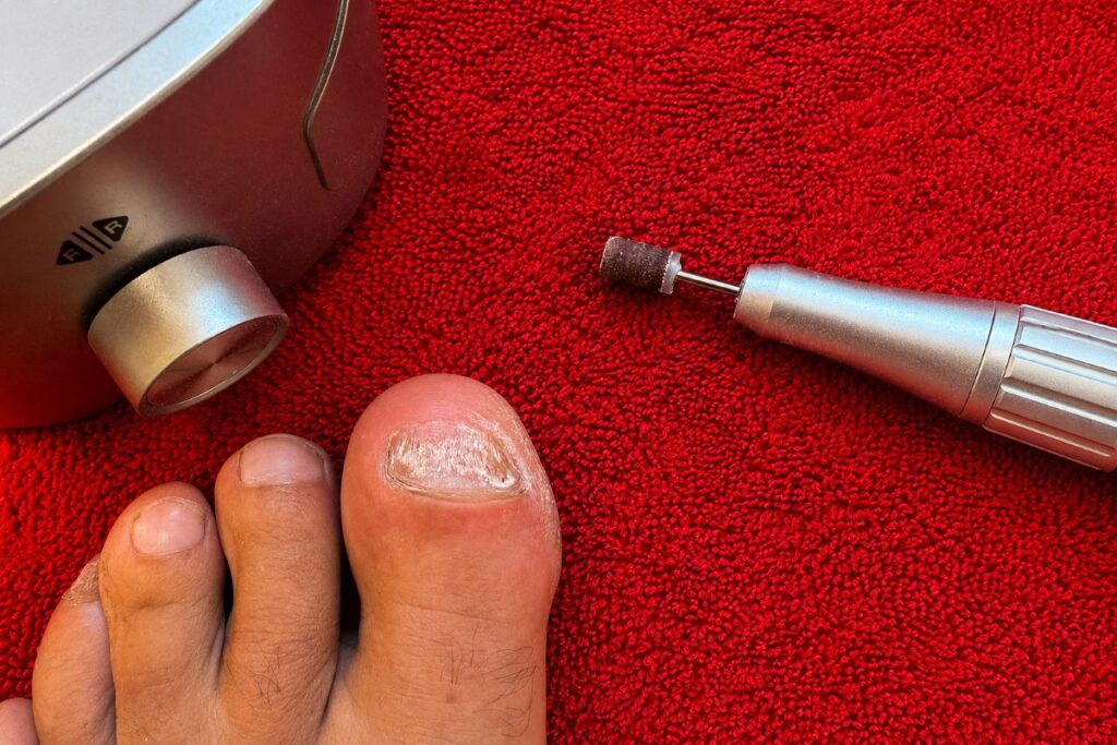 Nagelpilz vorsichtig mit Nagelfräser abschleifen