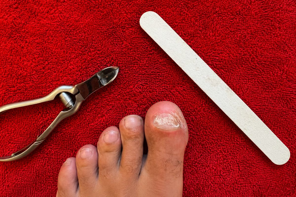 Nagelpilz abschleifen oder wegschneiden mit Feile und Nagelzange