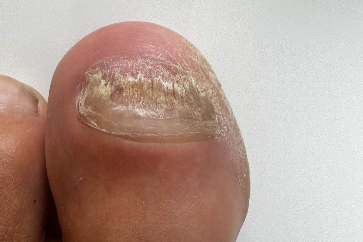 Nagelpilz Fußpflege Erfahrung am Zehennagel